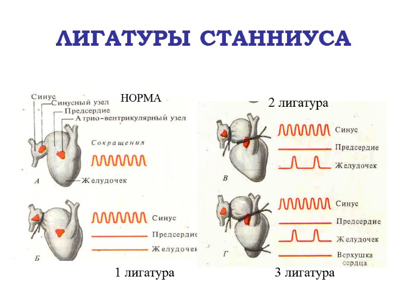 ЛИГАТУРЫ СТАННИУСА НОРМА 1 лигатура 2 лигатура 3 лигатура